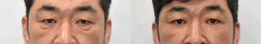 before and after lower blepharoplasty