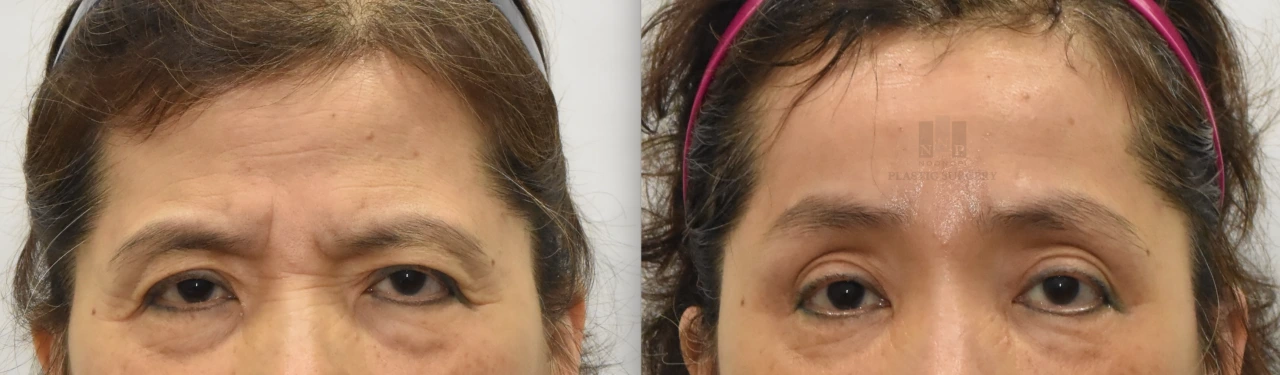 Korean endotine forehead lift before after