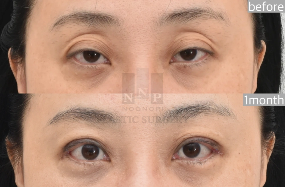 droopy eyes surgery