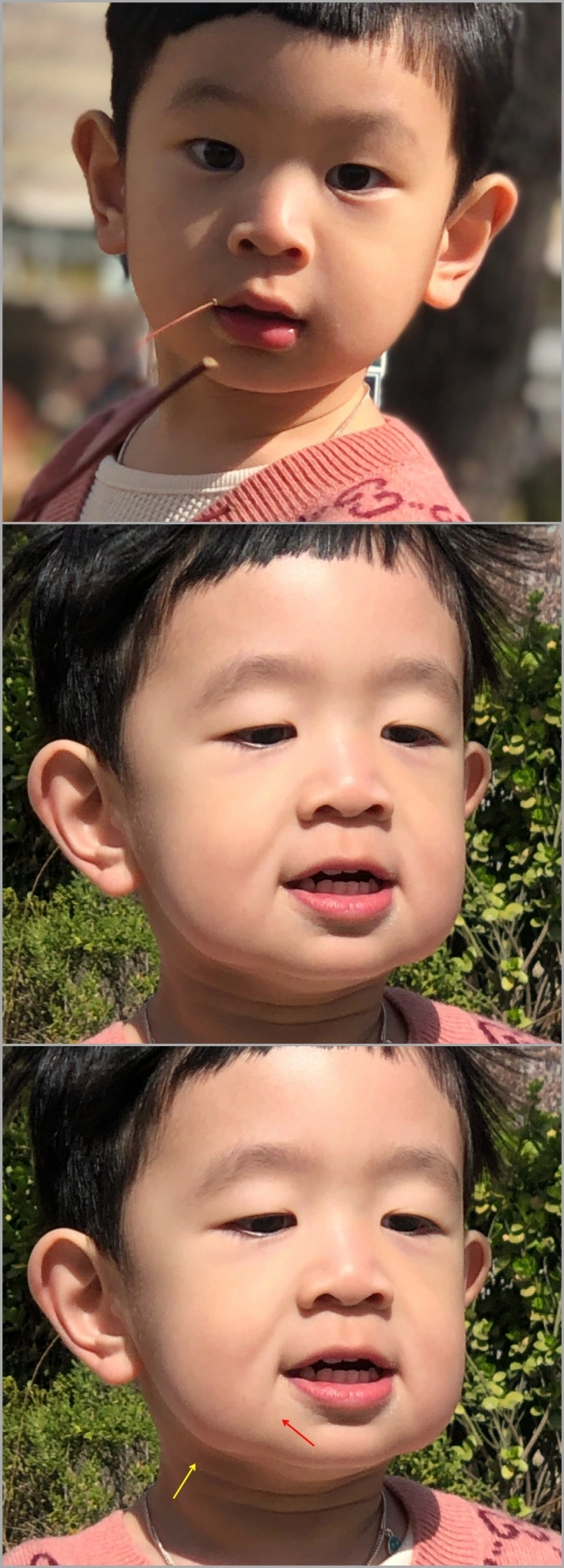 얼굴 처짐 원인