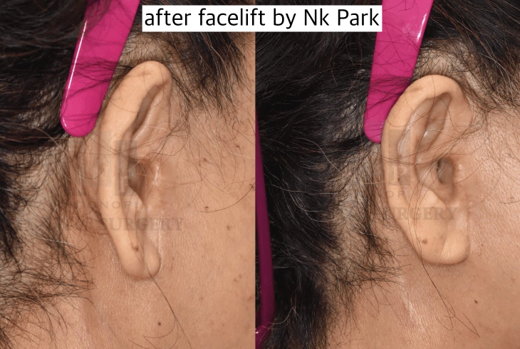 invisible facelift scar