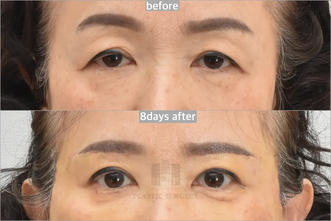 Under-brow lift 8 days after