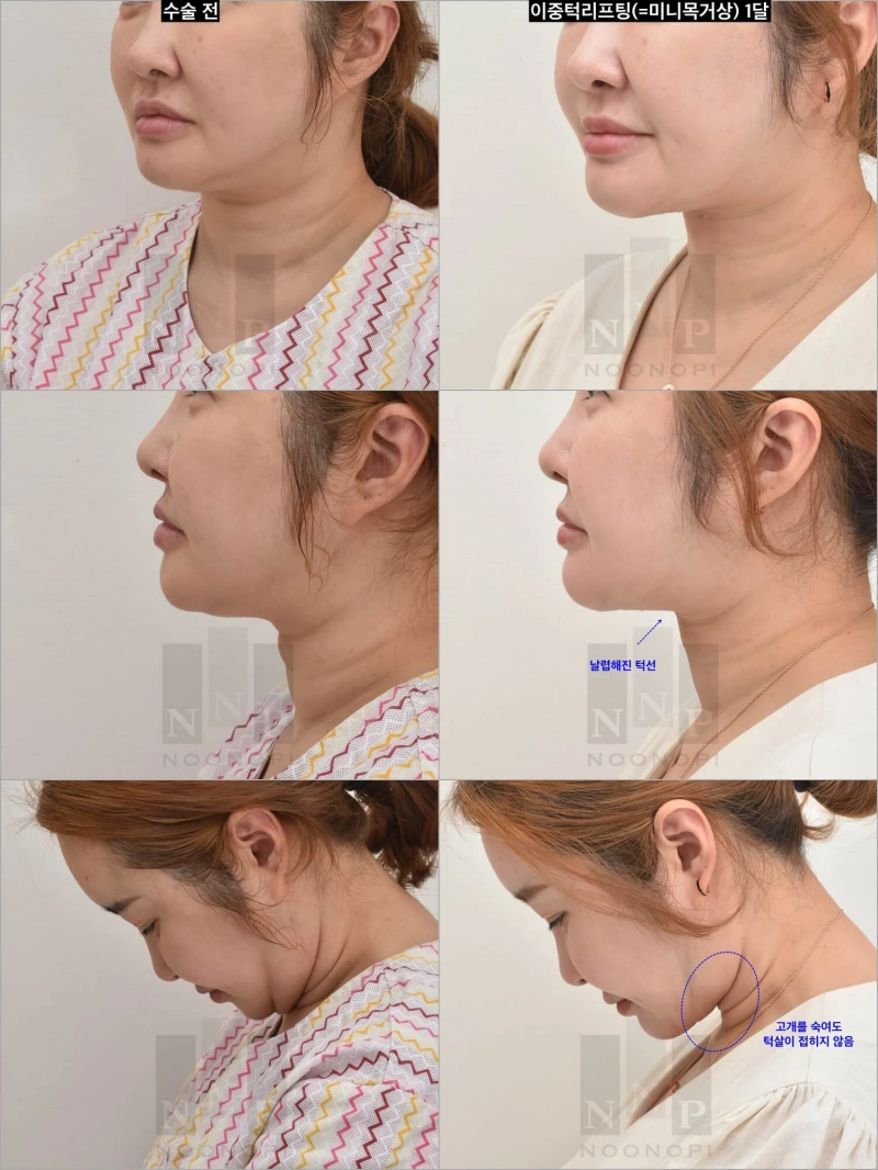 double chin surgery korea