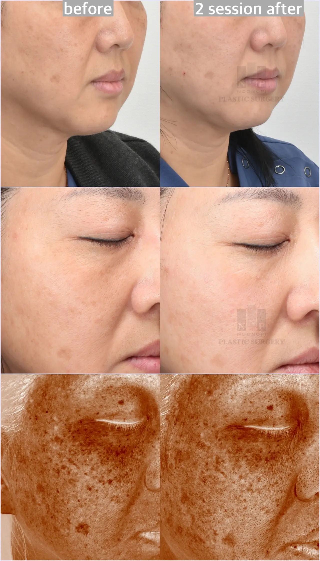 BBL HERO results in Korean clinic