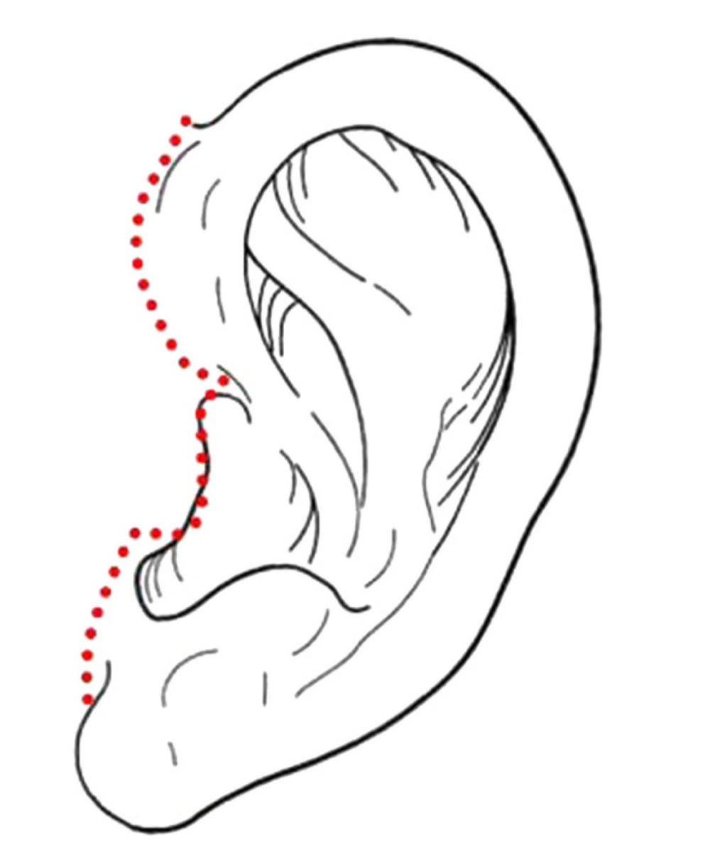 posterior tragus incision