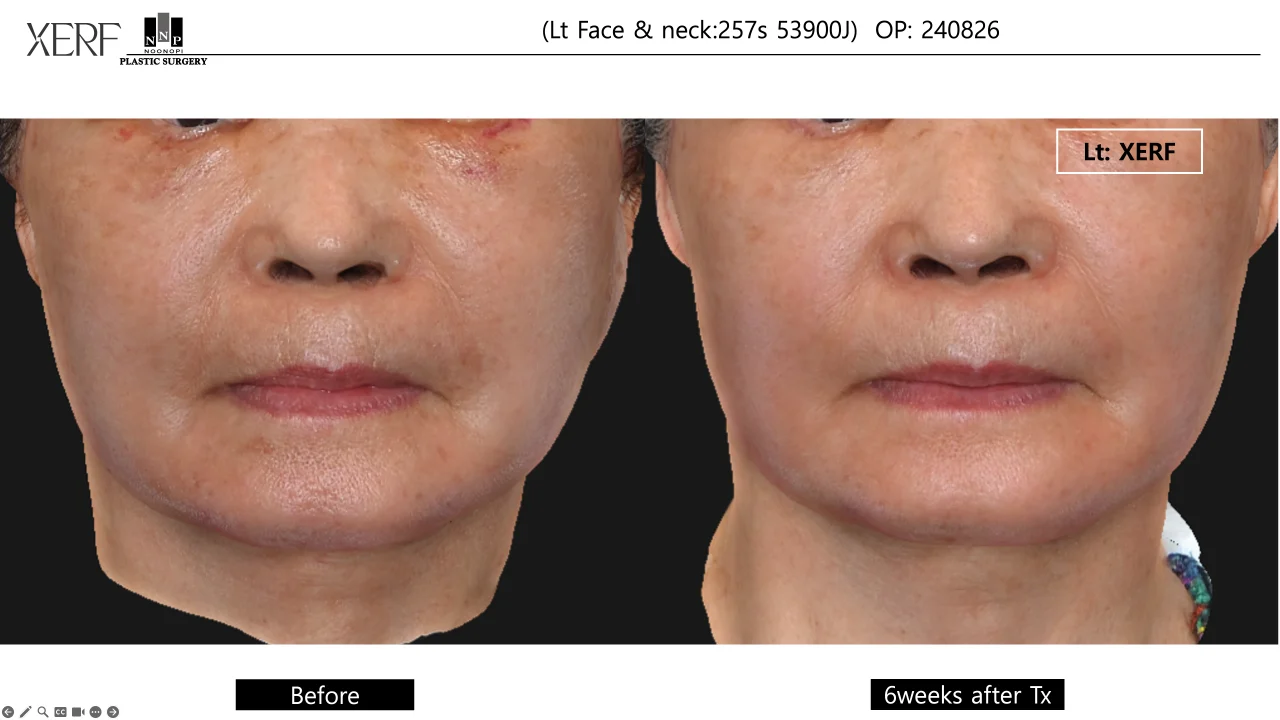 Clinical study XERF safety post facelift