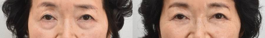 lower blepharoplasty Korea reviews